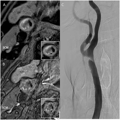 Identification of Carotid Artery Microstructure and Plaque Rupture Using C-Arm Cone-Beam CT: A Case Report